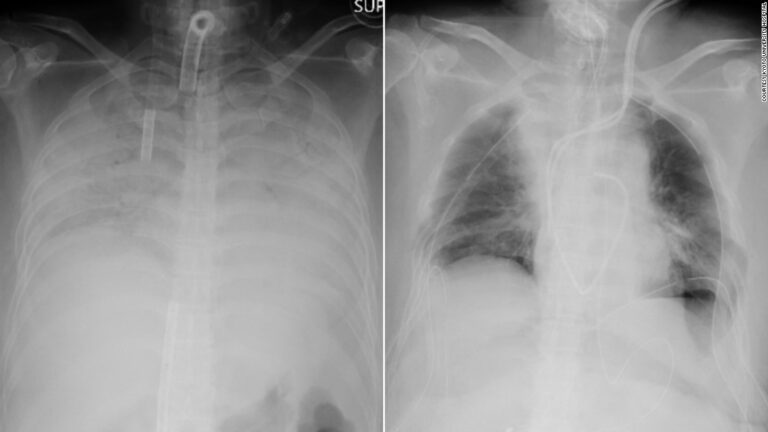 Japanese doctors perform world’s first living donor lung transplant to a Covid-19 patient