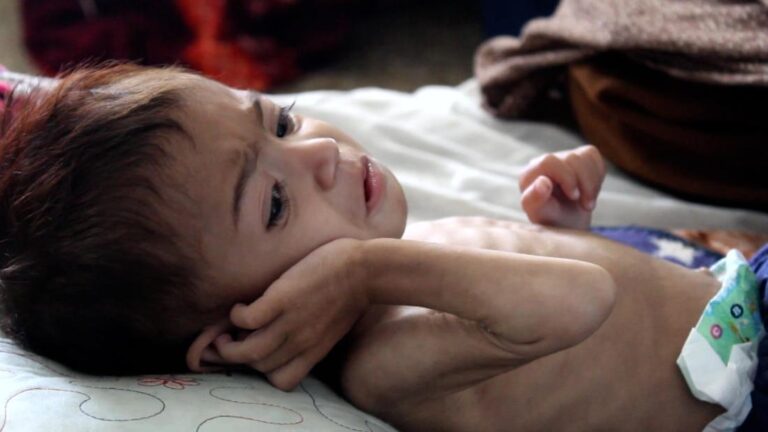 She’s nearly 3 but as small as an infant. This is the face of Afghanistan’s hunger crisis