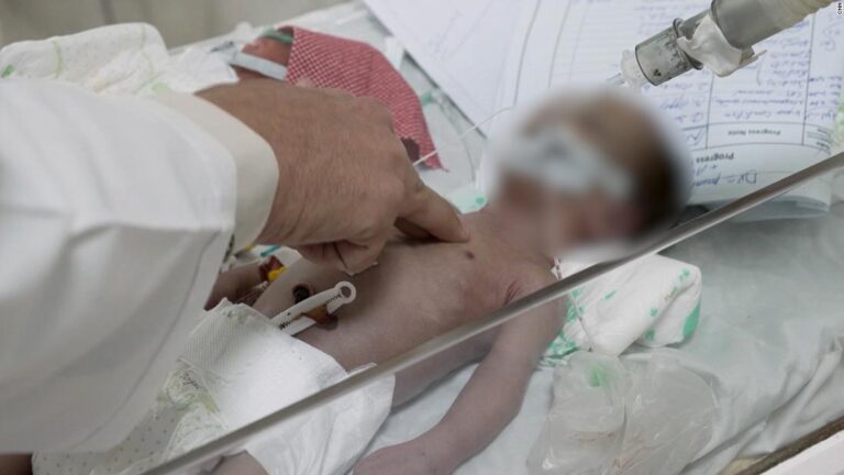 Doctor brings malnourished baby back from the brink of death