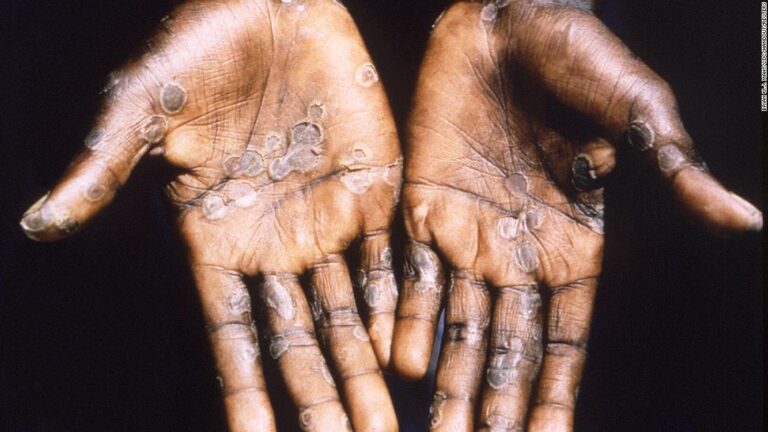 What is monkeypox and its signs and symptoms?